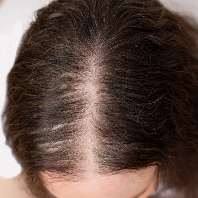FEMALE HAIR LOSS SOLUTIONS THE HAIR LOSS CLINIC UK FEMALE HAIR LOSS SOLUTIONS THE HAIR LOSS CLINIC UK