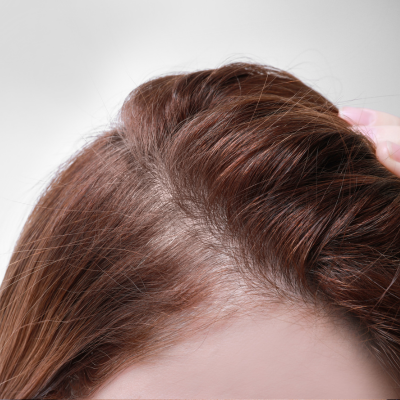 FPHL SOLUTIONS THE HAIR LOSS CLINIC UK FPHL SOLUTIONS THE HAIR LOSS CLINIC UK