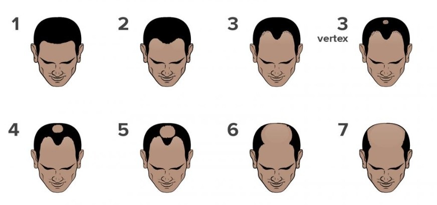 The best online hair loss consultations in the UK The best online hair loss consultations in the UK