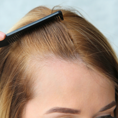 THINNING HAIR TREATMENTS ONLINE AT THE HAIR LOSS CLIIC UK THINNING HAIR TREATMENTS ONLINE AT THE HAIR LOSS CLIIC UK