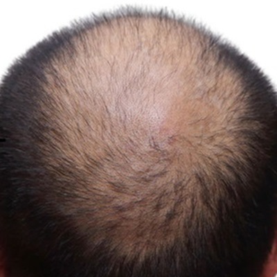 online hair loss serums at The Hair Loss Clinic Uk online hair loss serums at The Hair Loss Clinic Uk
