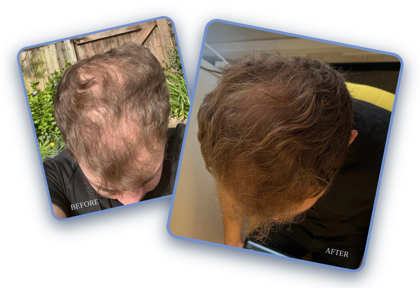 PATCHY HAIR LOSS SOLUTIONS AT THE HAIR LOSS CLINIC UK PATCHY HAIR LOSS SOLUTIONS AT THE HAIR LOSS CLINIC UK