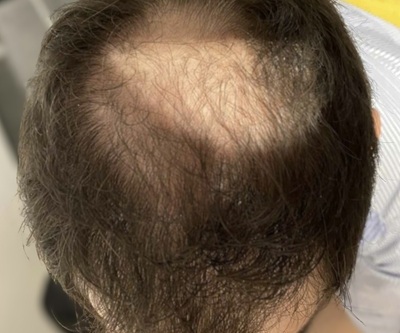 ONLINE PHARMACEUTICAL HAIR LOSS SERUMS UK ONLINE PHARMACEUTICAL HAIR LOSS SERUMS UK