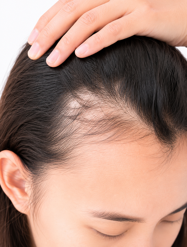 Hair Loss Treatments For Women Hair Loss Treatments For Women