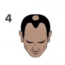 Stage 4