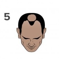Stage 5